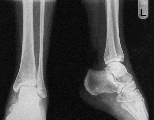 Orthobullets cuboid fracture